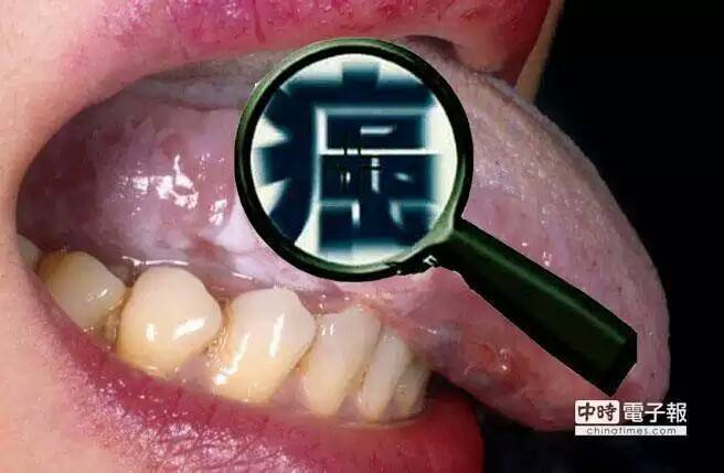 易被忽略的粘膜組織情境圖片